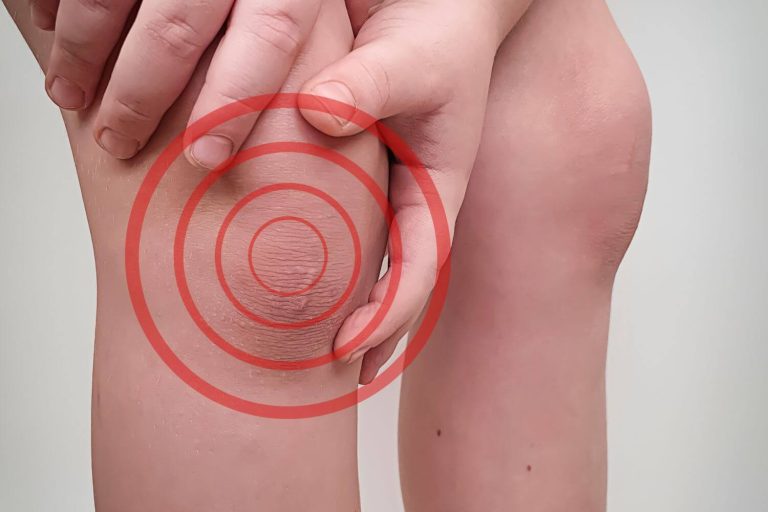especialista en osteocondritis disecante de rodilla en CDMX